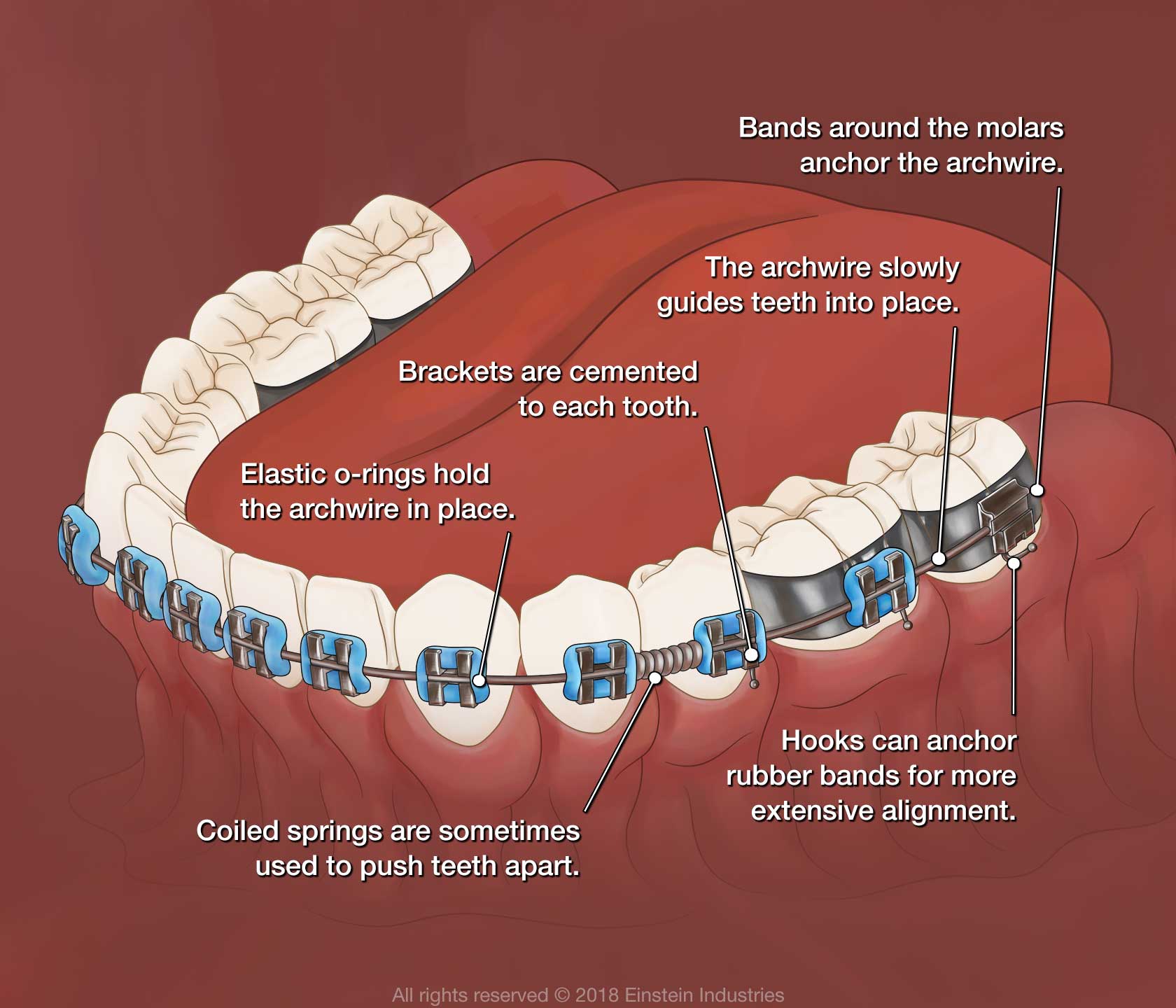 Illustration of how braces work