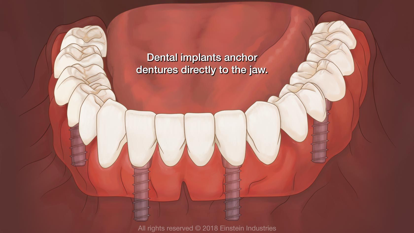 An illustration of implant-supported dentures