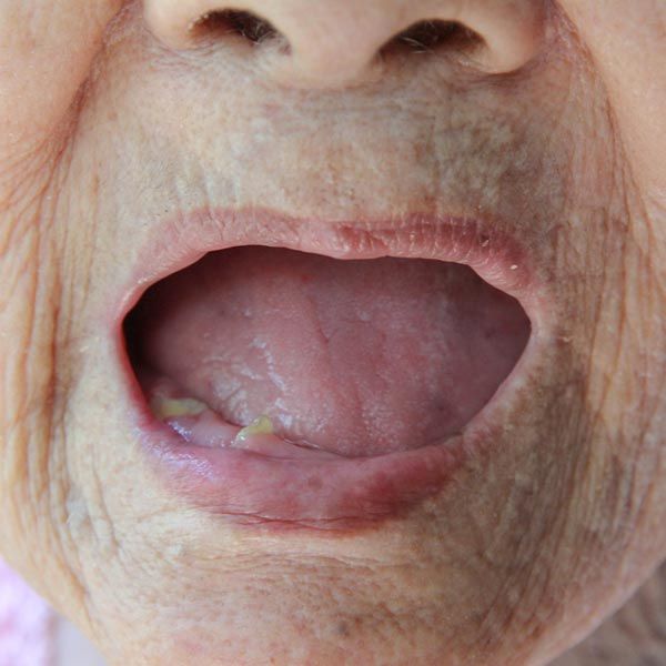 A full arch of missing teeth