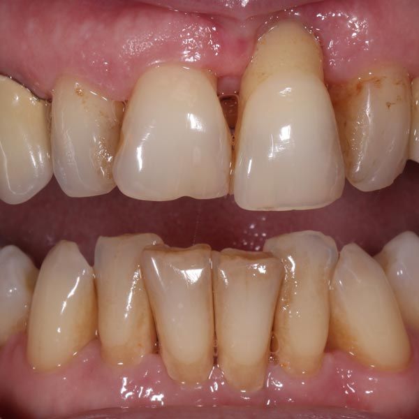 Damaged teeth