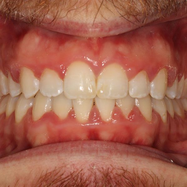 straightened smile after Invisalign