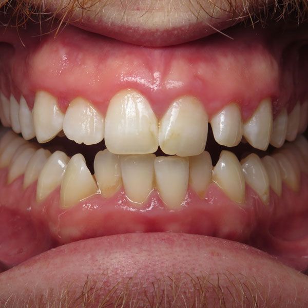 crooked teeth before Invisalign